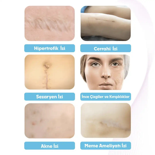 Premium Soft Silikon Yara İzi Bandı