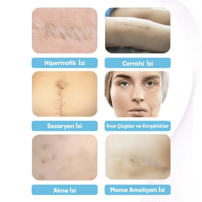 Premium Soft Silikon Yara İzi Bandı